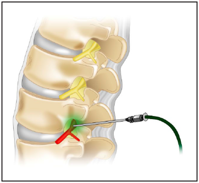 SlippedDisc_fig6.png