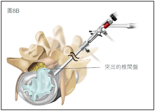 SlippedDisc_fig8b TC.jpg