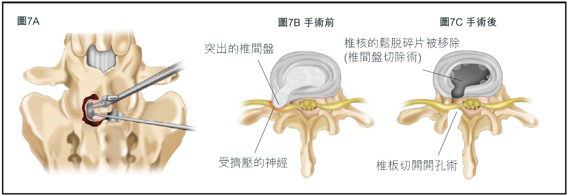 SlippedDisc_fig7 TC.jpg