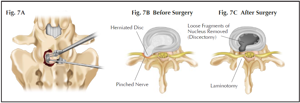 SlippedDisc_fig7.png