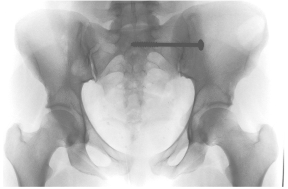 Fig 8 SI fusion X ray.jpg