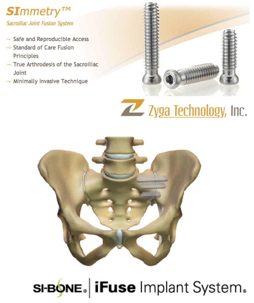 Fig 9 SI joint fusion implant.jpg