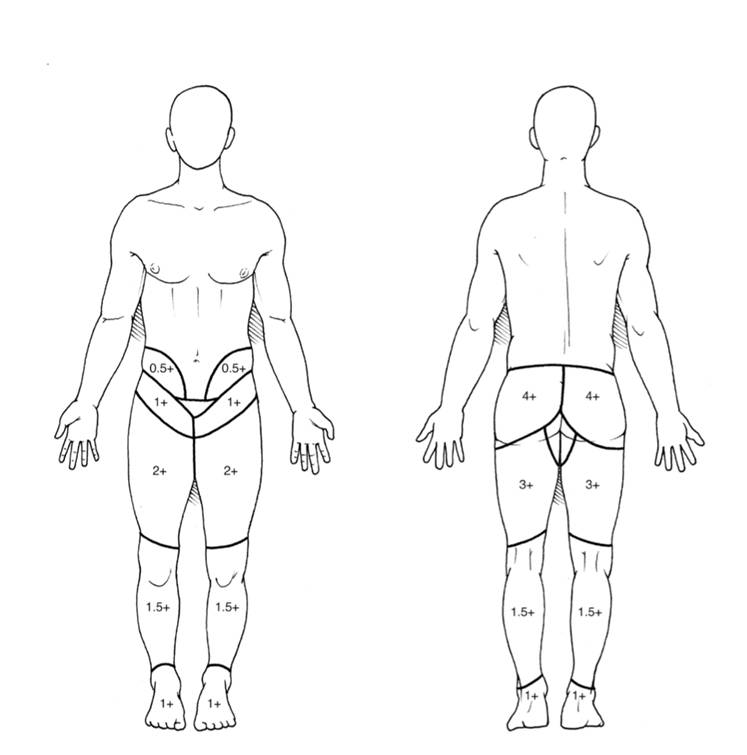 Fig 4 Pattern of SI joint pain radiation_v2.jpg