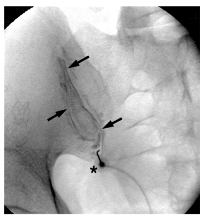 Fig 5 SI joint injection.jpg