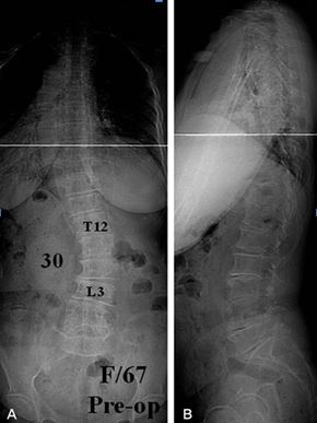 Deg.AdultScoliosis_fig3.JPG