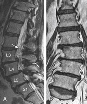 Deg.AdultScoliosis_fig4.JPG