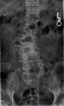 Deg.AdultScoliosis_fig1.JPG