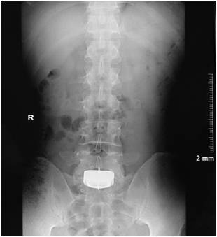 Lumbar disc 1.jpg