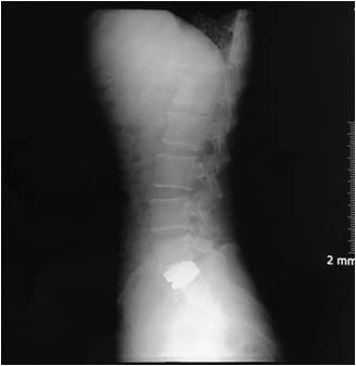 Lumbar disc 2.jpg